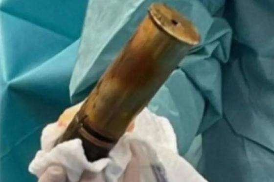 Idoso assusta médicos ao chegar com bomba presa no ânus