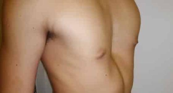 pectus peito de pombo