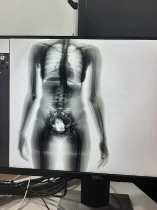MULHER TENTA ENTRAR COM DROGAS NA VAGINA