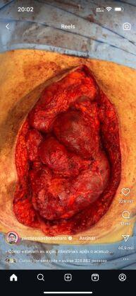 barriga 