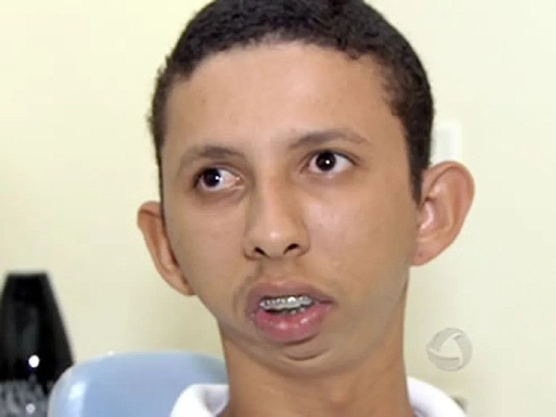 Luiz nasceu de parto normal e o médico teria utilizado um 'forceps'