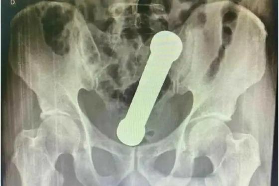 objeto no anus 
